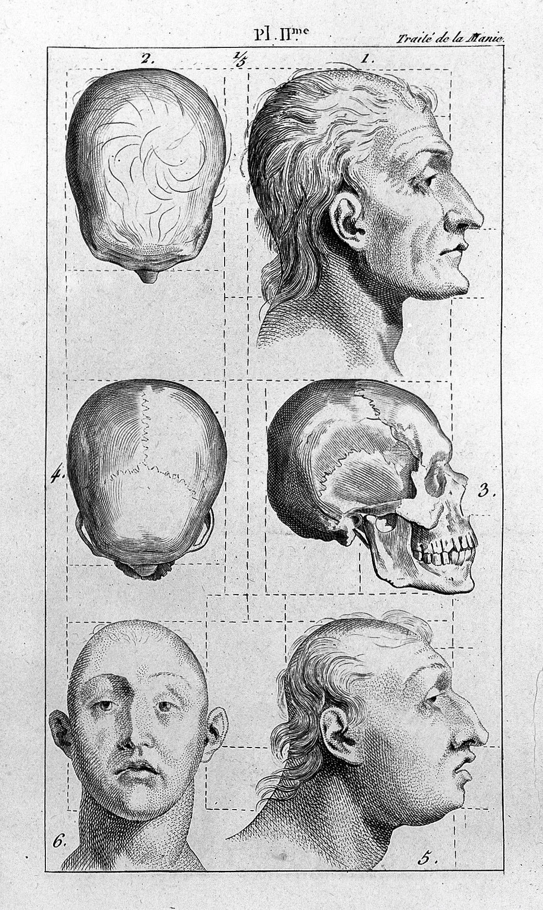Abbildung aus Philippe Pinels "Traité médico-philosophique sur l'aliénation mentale, ou la manie" (1801) 